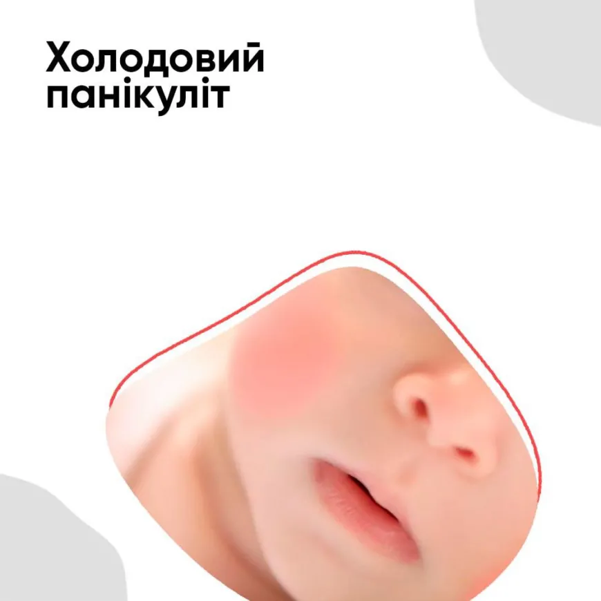 Холодовий панікуліт