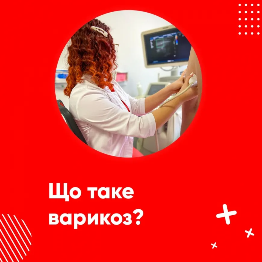 Що таке варикоз?
