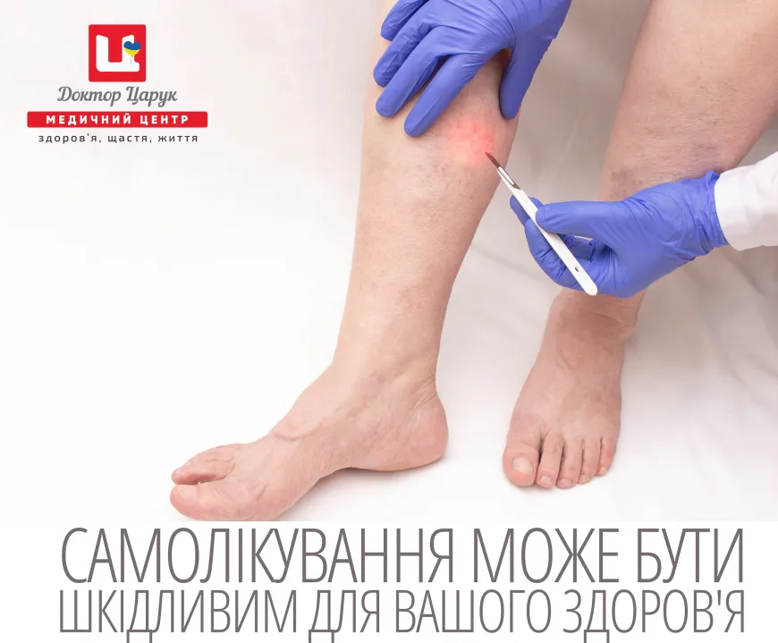 Трофічна виразка на ногах