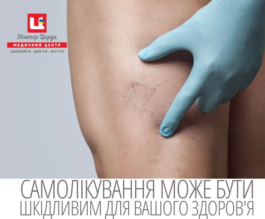 Облітеруючий тромбангіїт, хвороба Бюргера та ендартеріїт - консультація флеболога