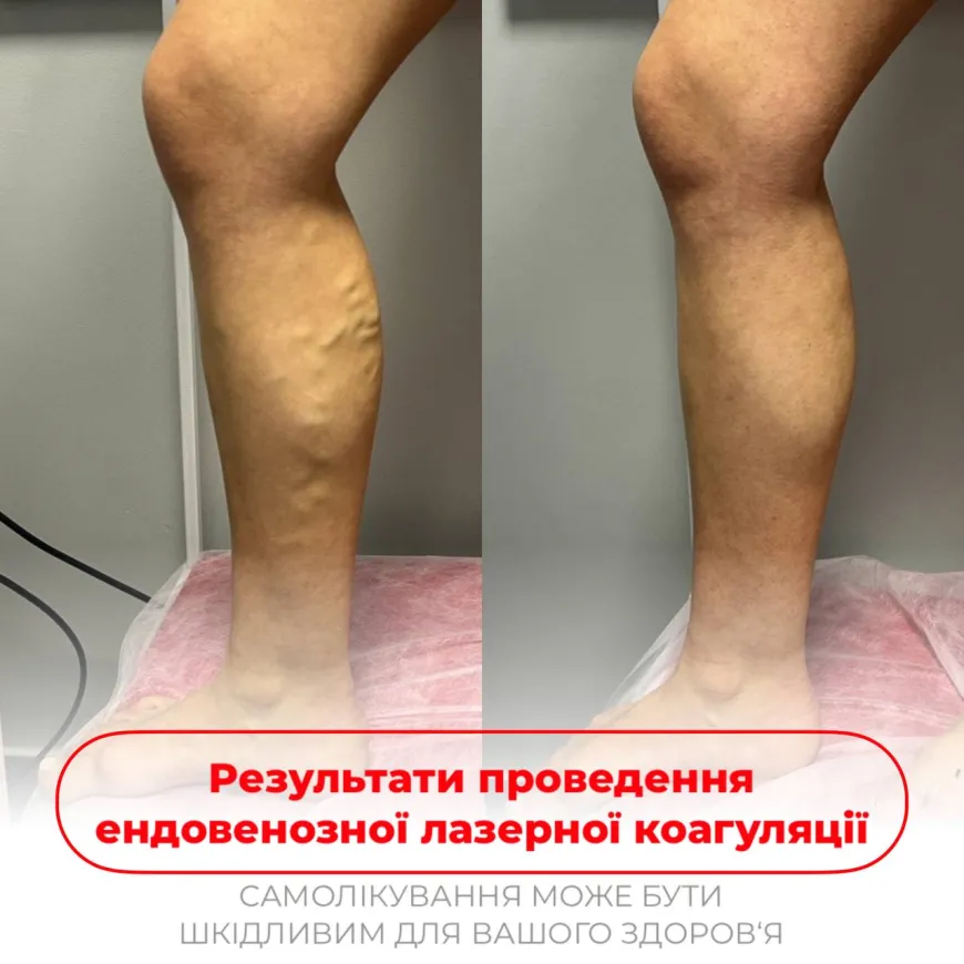 Ендовенозна лазерна коагуляція системою Biolitec (Німеччина)